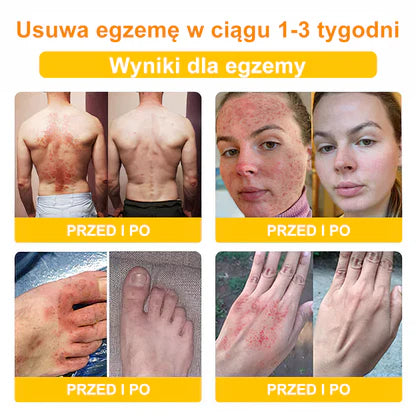 Krem DermaSoothe na łuszczycę i egzemę