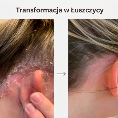 Krem DermaSoothe na łuszczycę i egzemę